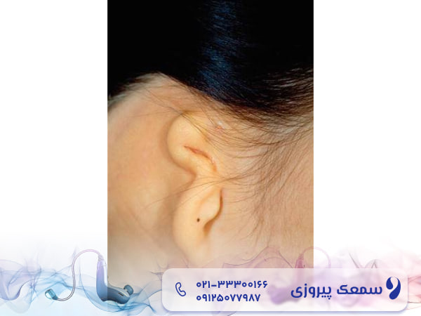 آتزری کانال گوش